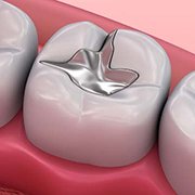 mercury filling inflammation sm 180 x 180